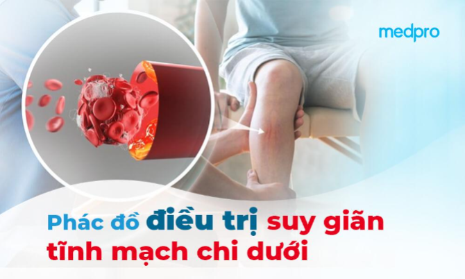 Phác đồ điều trị giãn tĩnh mạch chi dưới: Giải pháp tối ưu cho sức khỏe đôi chân