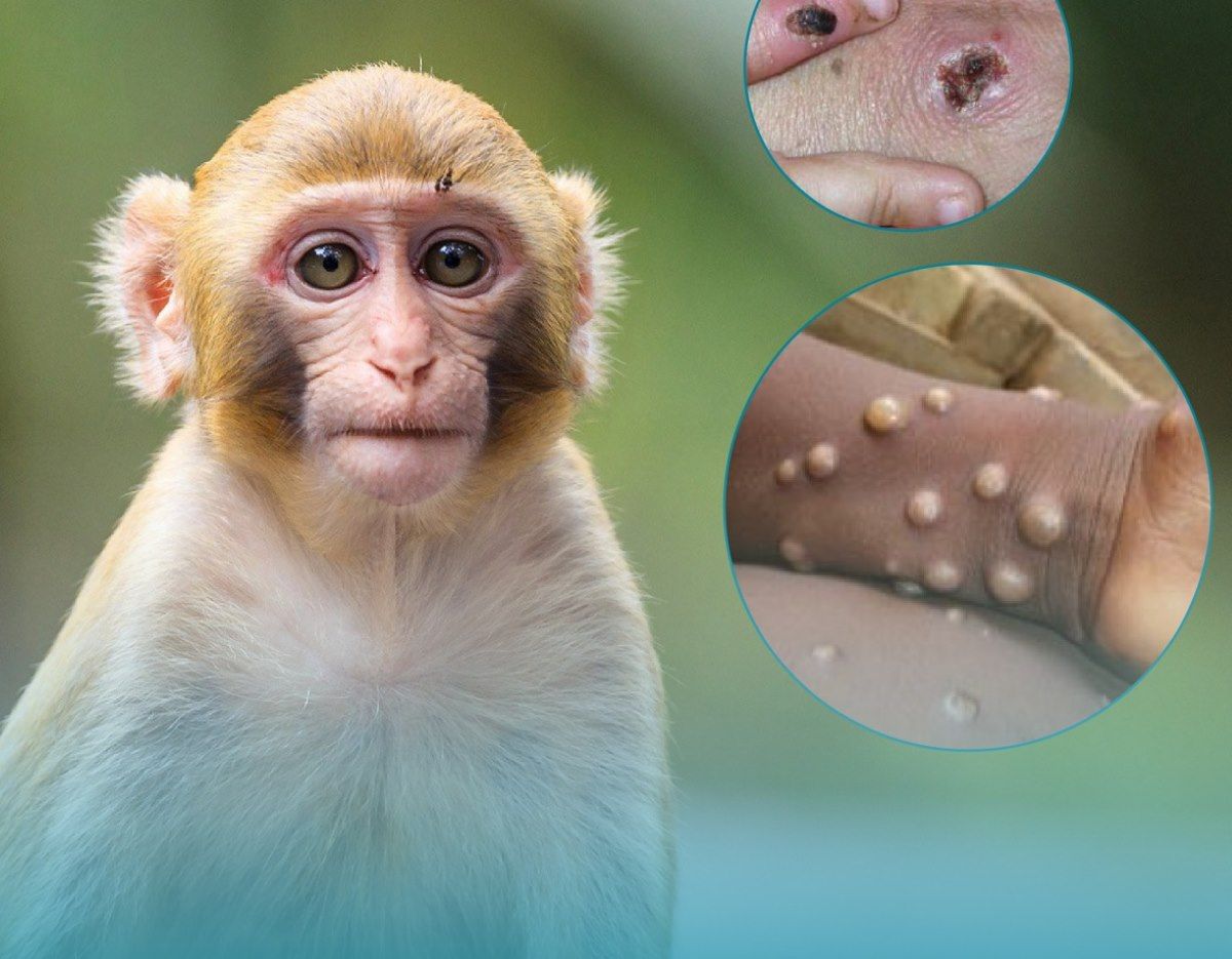 Hình ảnh minh họa về bệnh đậu mùa khỉ