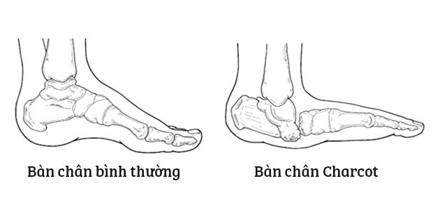 Biến chứng bàn chân Charcot - bị biến dạng so với lúc ban đầu ở người có bệnh lý bàn chân đái tháo đường. Nguồn: Internet