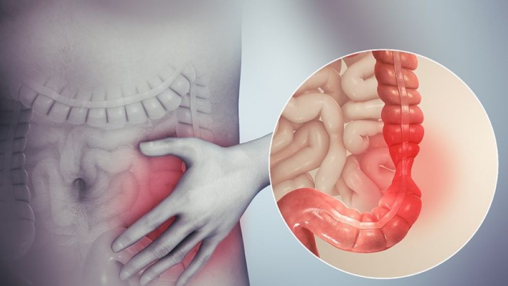 Hội chứng ruột kích thích (IBS)