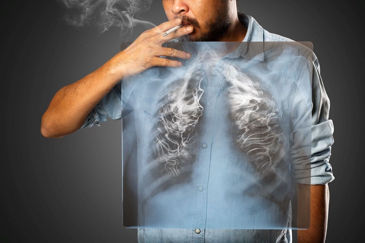 Hơn 80% ca mắc ung thư phổi bắt nguồn từ khói thuốc lá
