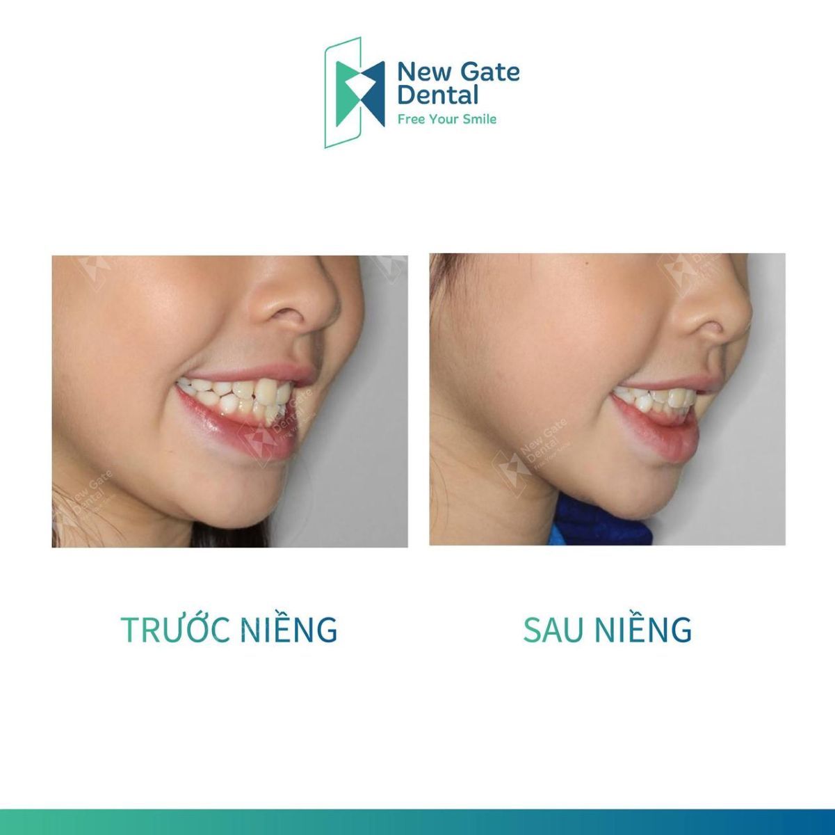 Hình ảnh trước và sau khi tháo niềng răng mắc cài tại Nha khoa Newgate. Nguồn: Fanpage phòng khám