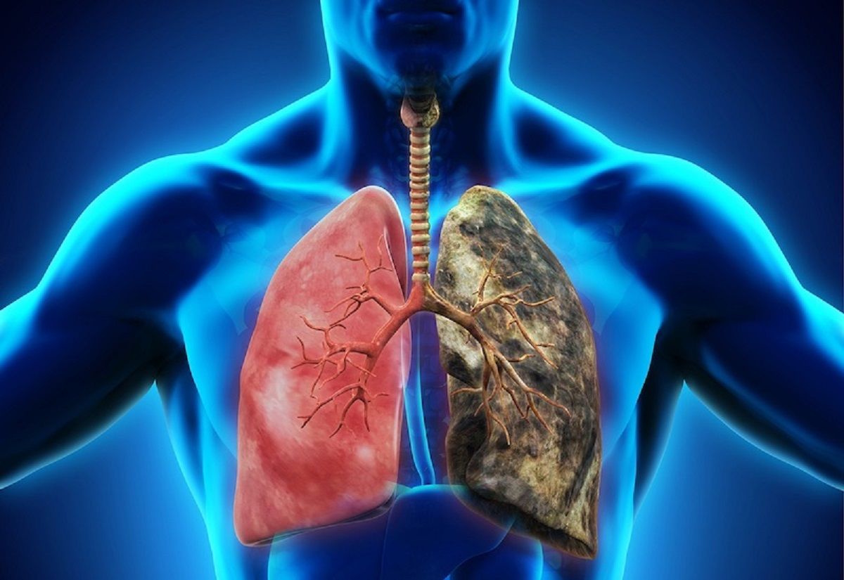 Ung thư phổi là một loại ung thư ác tính với mức độ phổ biến cao
